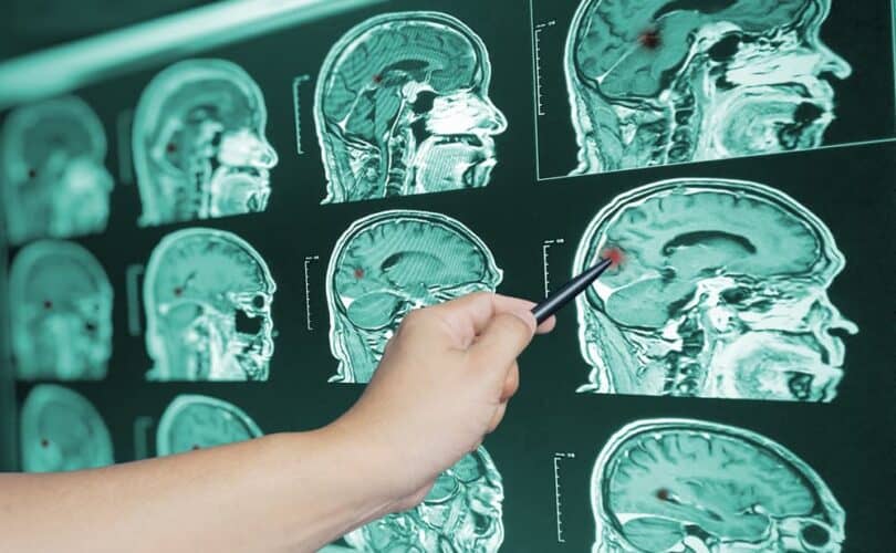 Doctor Pointing At Multiple Brain Scan Images On The Wall